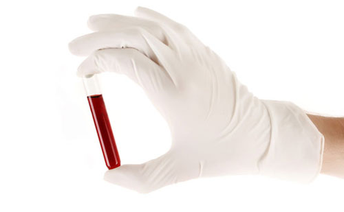 Kiểm tra máu có thể phát hiện bệnh ung thư giai đoạn 1