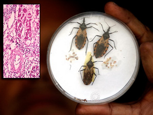 Bọ hút máu Triatoma có mang theo ký sinh trùng trypanosomiasis gây ra bệnh Chagas
