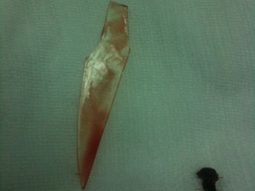 Mảnh kiếng nhọn được các bác sĩ lấy ra từ màng phổi cháu Mai