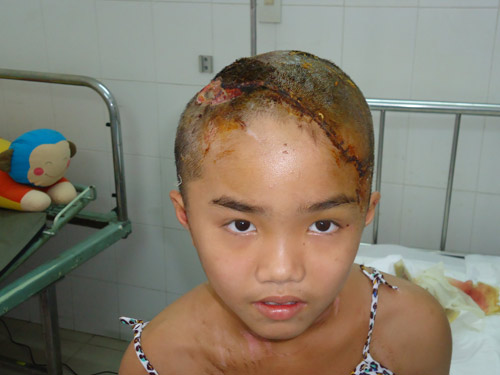 Vụ ghép da đầu cho cháu Như Ý: Thành công của vi phẫu tạo hình
