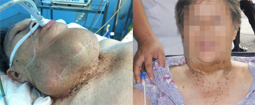 Bệnh nhân L.M.A trước và sau khi được phẫu thuật cắt bỏ bướu cổ 