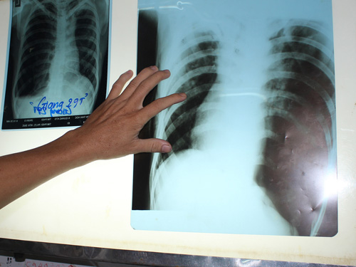 Hình ảnh X-quang của bệnh nhân Giang