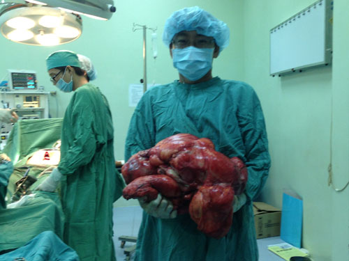 Lấy khối u nặng 11kg ra khỏi bụng bệnh nhân