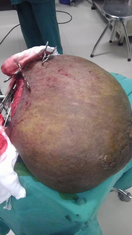 Cắt bỏ khối u khổng lồ nặng 18 kg