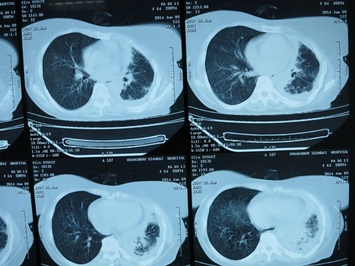 Bệnh viện ung bướu hiện đại Quảng Châu làm teo nhỏ khối u phổi