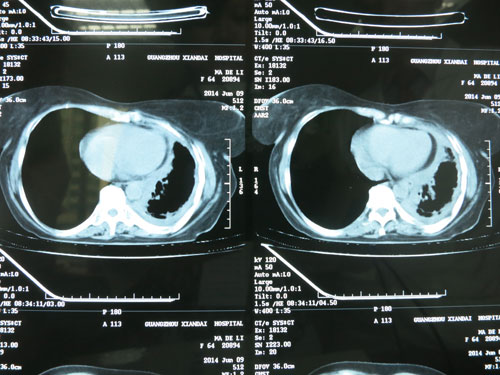 Bệnh viện ung bướu hiện đại Quảng Châu làm teo nhỏ khối u phổi
