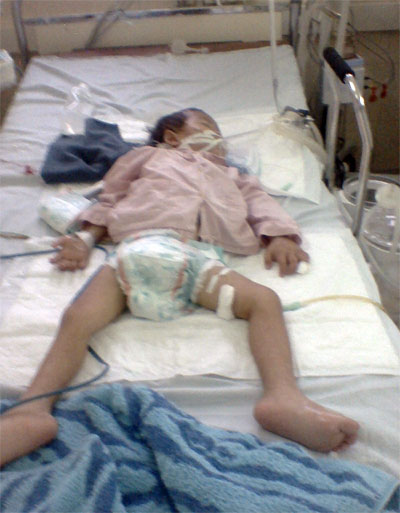 Bé 3 tuổi nguy kịch vì nhiễm nấm nhưng điều trị bệnh lao