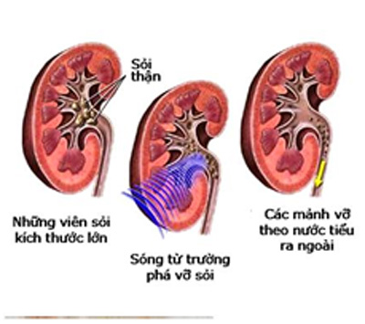 Phương pháp điều trị bệnh sỏi thận 2