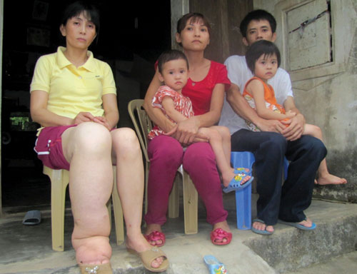 Chị Dũng “chân voi” cùng gia đình nghèo khó của em trai - Ảnh: Nguyên Dũng