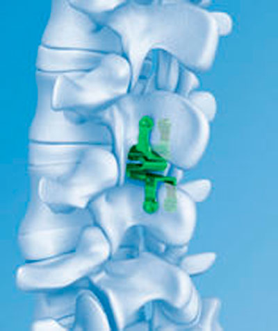 Dụng cụ cấy ghép xương cột sống (Interspinous vertebral implant - Stenofix)