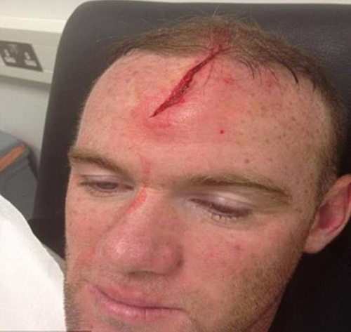 Rooney bị rách trán ghê rợn