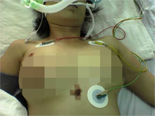 Một bệnh nhân đang được chữa trị do liên quan đến việc bơm silicon - Ảnh minh họa