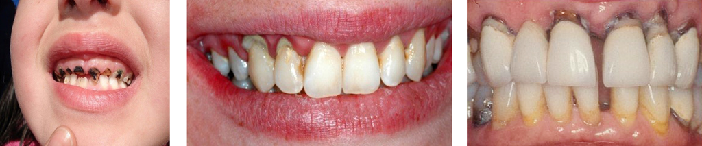 Sâu răng Vôi răng và Viêm nướu (Viêm lợi) Viêm nha chu (Viêm quanh răng)