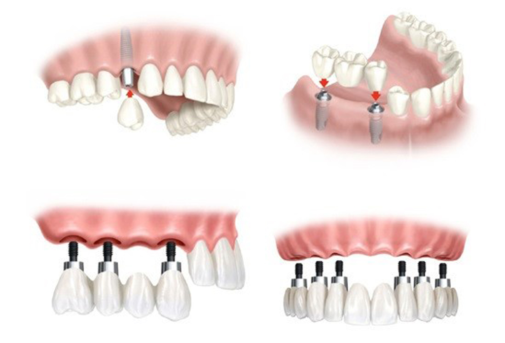 Phương pháp trồng răng Implant phù hợp với mọi tình trạng mất răng