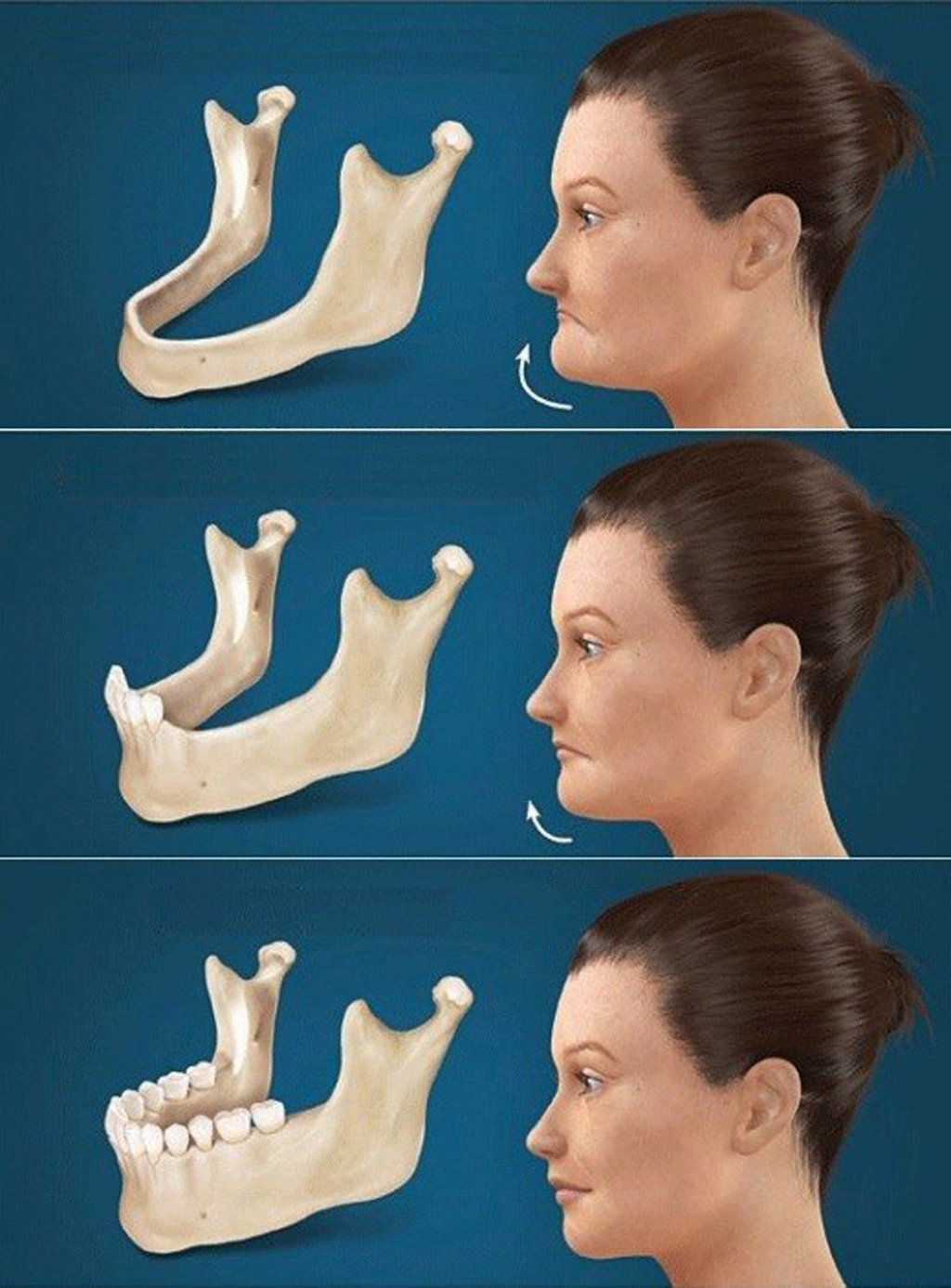 Diễn biến tình trạng tiêu xương hàm ở người mất răng
