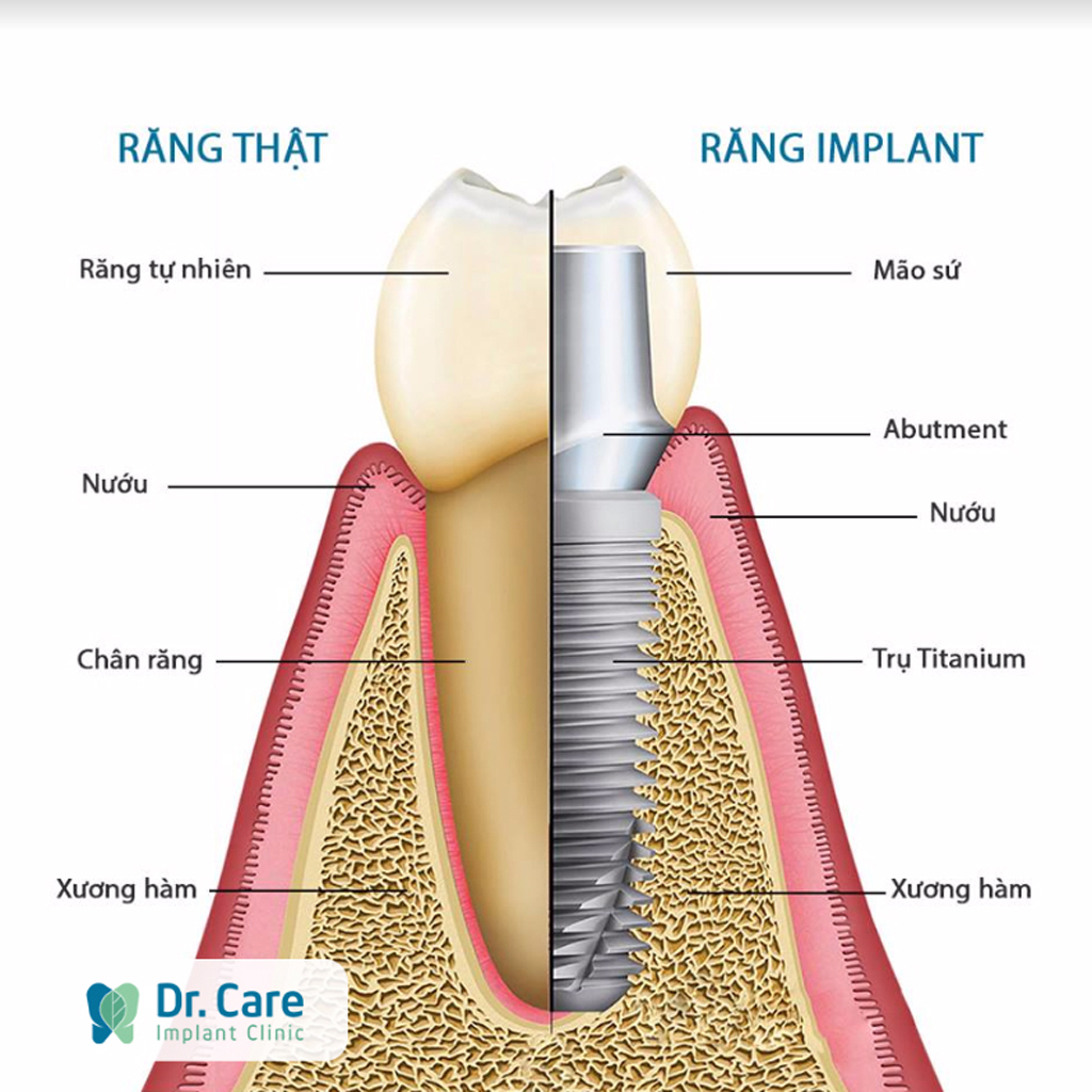 Răng Implant tích hợp với xương, đóng vai trò như răng thật