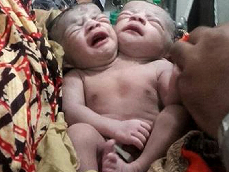 Bé gái sinh ra có hai đầu ở Bangladesh - Ảnh: AFP