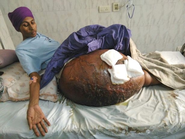 Gurmeet Singh trước khi trải qua phẫu thuật - Ảnh chụp màn hình Mirror
