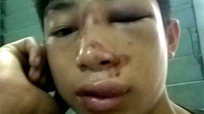 Phú đang điều trị tại Bệnh viện đa khoa Tuyên Hóa với nhiều vết thâm bầm trên mặt -  Ảnh gia đình Phú cung cấp