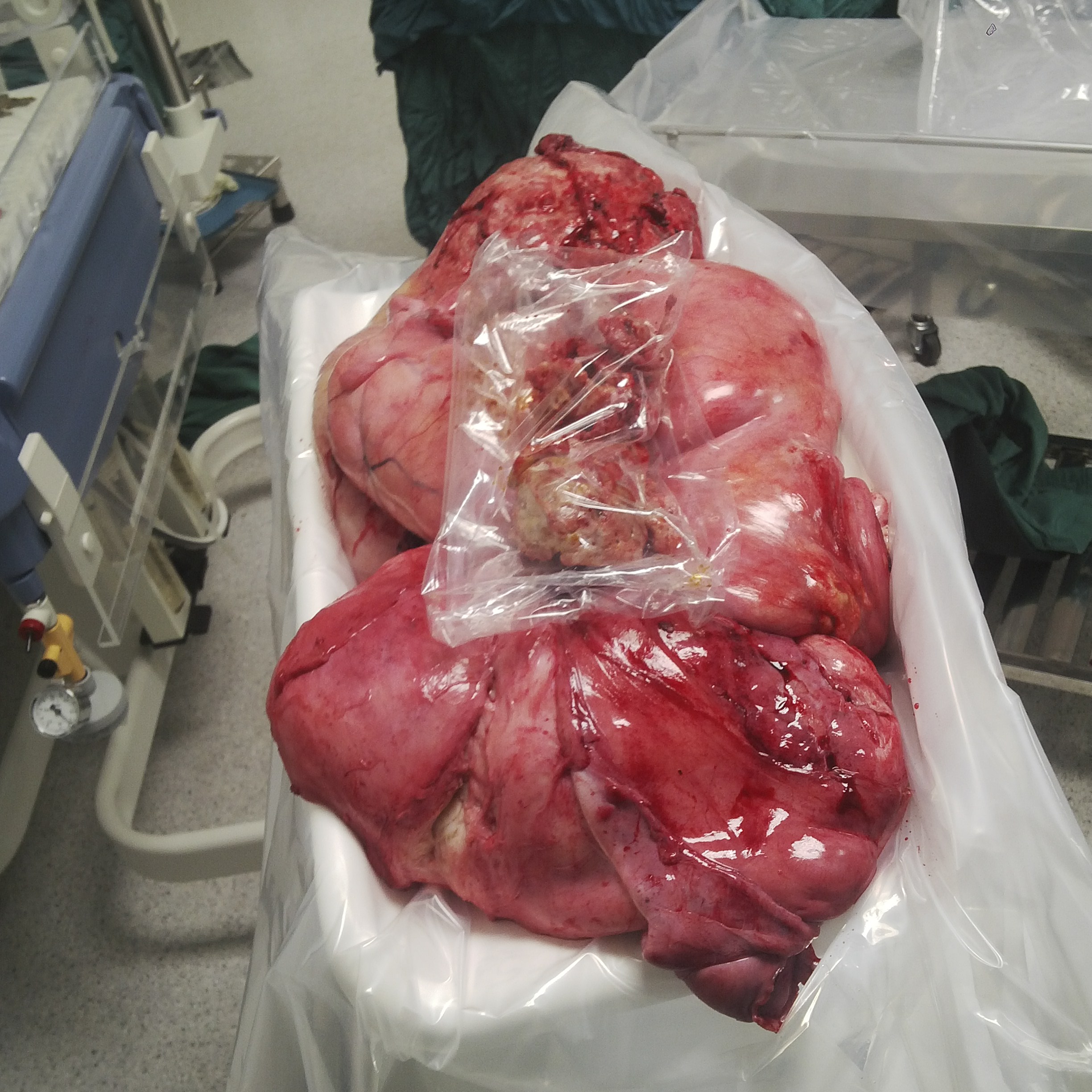 Khối u được phẫu thuật lấy ra ngoài - Ảnh: Bệnh viện đa khoa Đồng Nai cung cấp