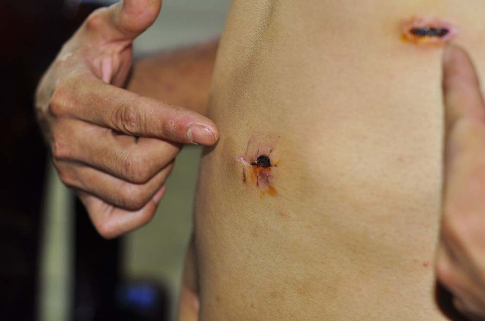 Vết thương do trúng đạn cao su trên ngực anh Hưng - Ảnh: Lê Lâm