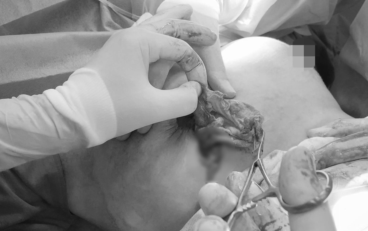 Bệnh viện JW cấp cứu bệnh nhân bị spa chui bỏ quên gạc trong ngực