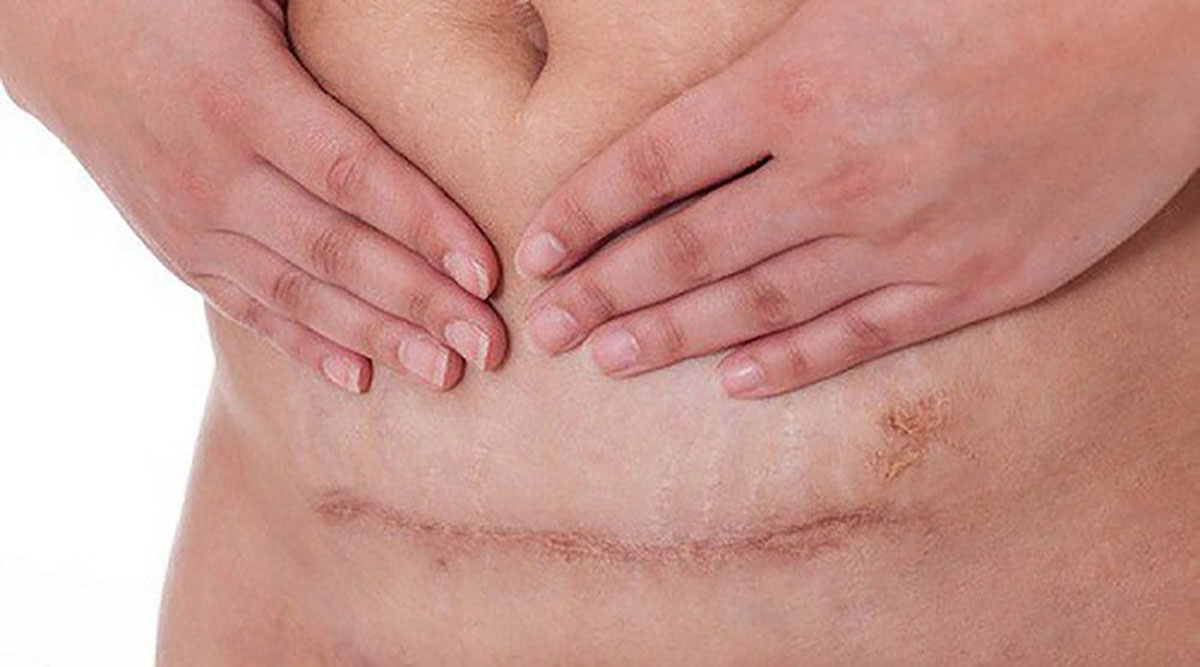 Vết sẹo mổ sau sinh gây mất thẩm mỹ làn da nghiêm trọng
