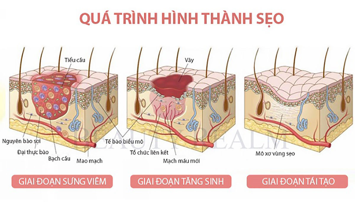 Quá trình hình thành sẹo lồi trên da