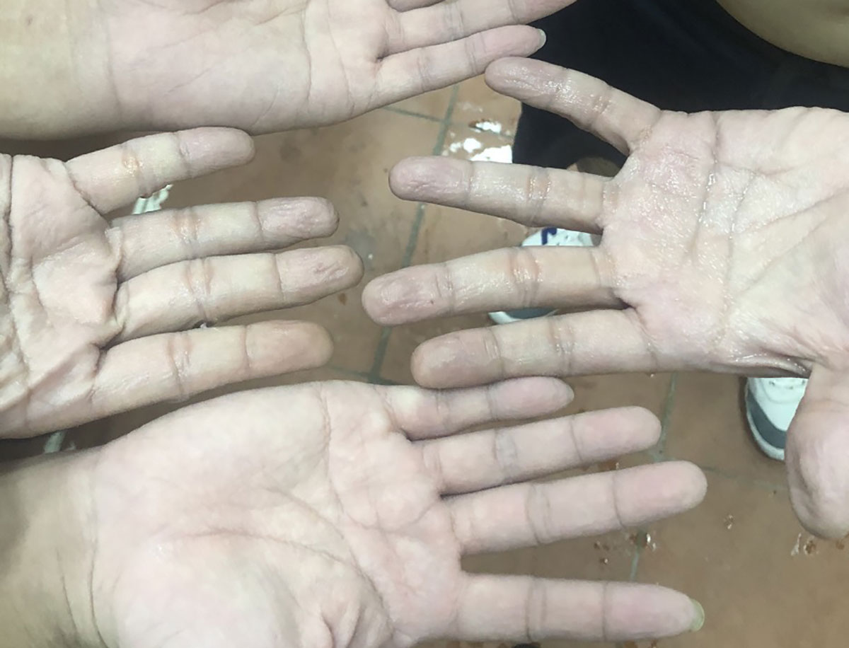 Đôi bàn tay nhiều nhân viên y tế nhăn nheo vì bị ngâm trong mồ hôi cả ngày 