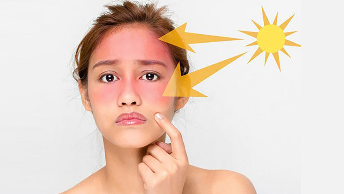 Tia UV có thể xuyên qua kính và gây cháy da, sạm màu da, lão hóa
