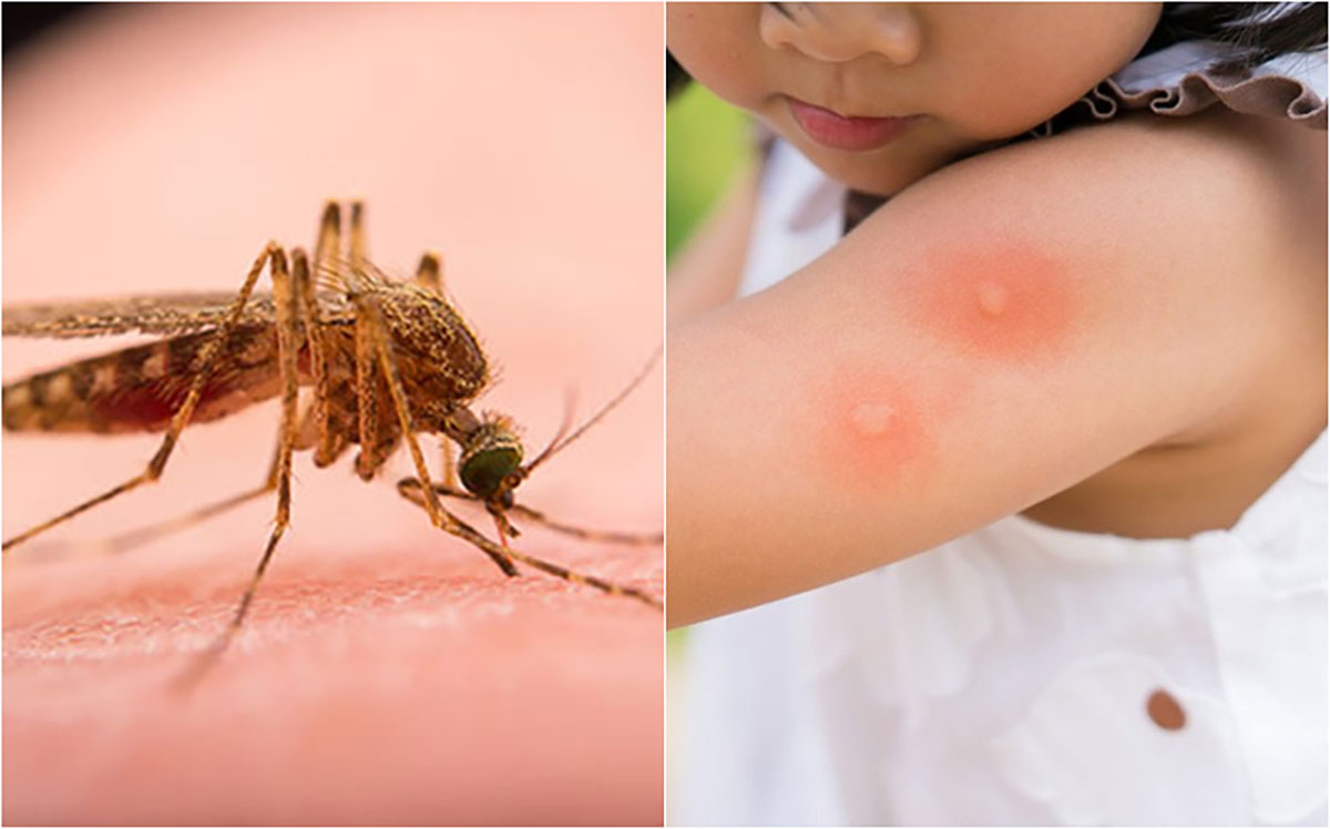 Trẻ em là đối tượng dễ bị ảnh hưởng bởi các bệnh liên quan đến côn trùng Trẻ em là đối tượng dễ bị ảnh hưởng bởi các bệnh liên quan đến côn trùng