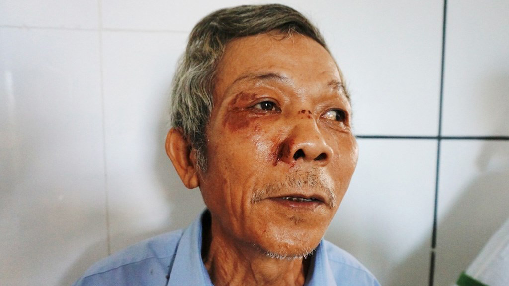 Ông Nguyễn Tấn Mức với nhiều vết thương ở vùng mặt đang điều trị tại Bệnh viện ĐH Y dược Huế - Ảnh: Tuyết Khoa