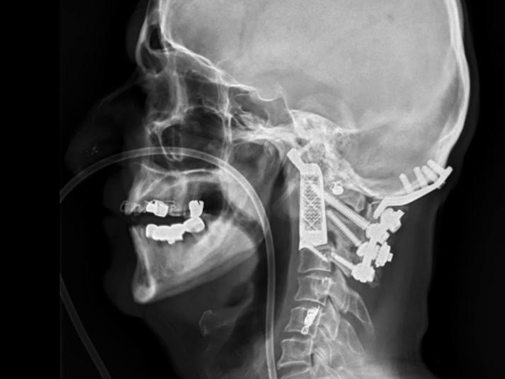 Ảnh chụp X-quang phần đốt sống cổ đã được thay thế - Ảnh: ABC Australia
