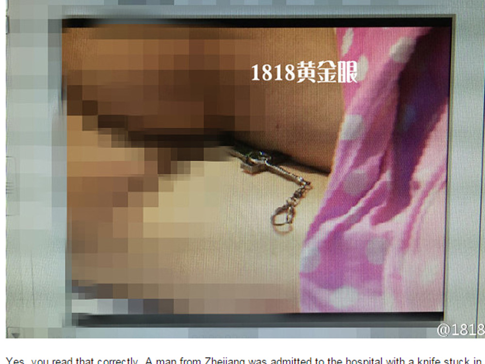 Con dao trong mông của bệnh nhân họ Nghiêm - Ảnh chụp màn hình trang tin Shanghaiist