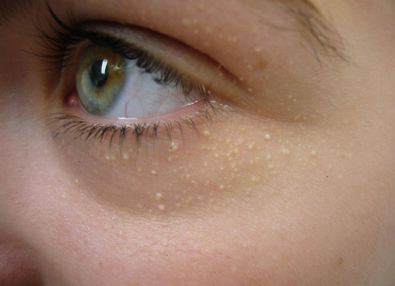 Mụn thịt là u tuyến mồ hôi thường xuất hiện nhiều ở vùng da quanh mắt