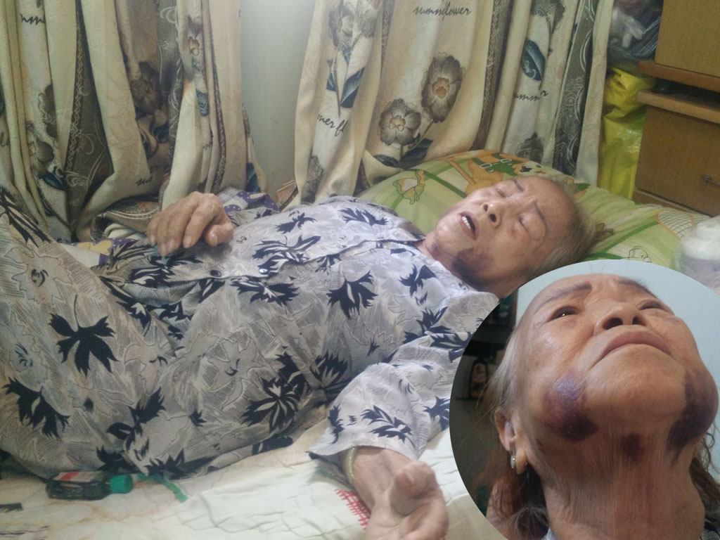 Bà Khương đang nằm điều trị sau khi bị con trai đánh đập và vết bầm trên cổ của bà (ảnh nhỏ) - Ảnh: Công Nguyên