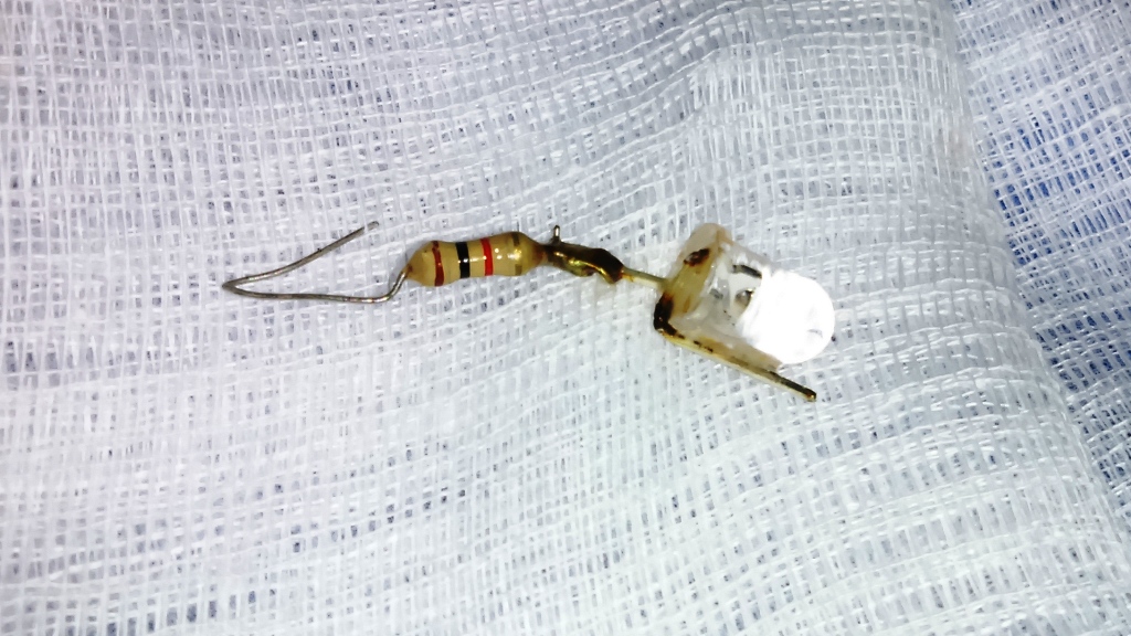 Dị vật tụ điện 0,8 x 1 cm, dây dẫn kim loại dài 2 cm được gắp ra ngoài do bé trai 10 tháng tuổi nuốt nhầm