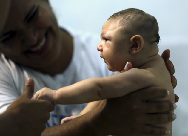 Em bé sơ sinh bị tật đầu nhỏ - Ảnh: Reuters