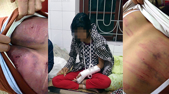 Em Nguyễn Thị T.14 tuổi đang phải chịu những tổn thương nghiêm trọng về thể xác và tinh thần từ người bố đẻ của mình