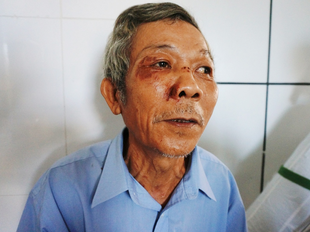 Ông Nguyễn Tấn Mức với nhiều vết thương ở vùng mặt đang điều trị tại Bệnh viện ĐH Y dược Huế - Ảnh: Tuyết Khoa