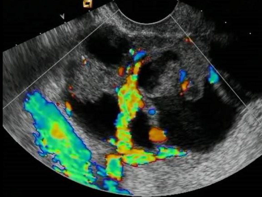 Trong nhiều trường hợp, siêu âm lại có khả năng xác định khối u tốt hơn MRI - Ảnh chụp màn hình Medical Daily