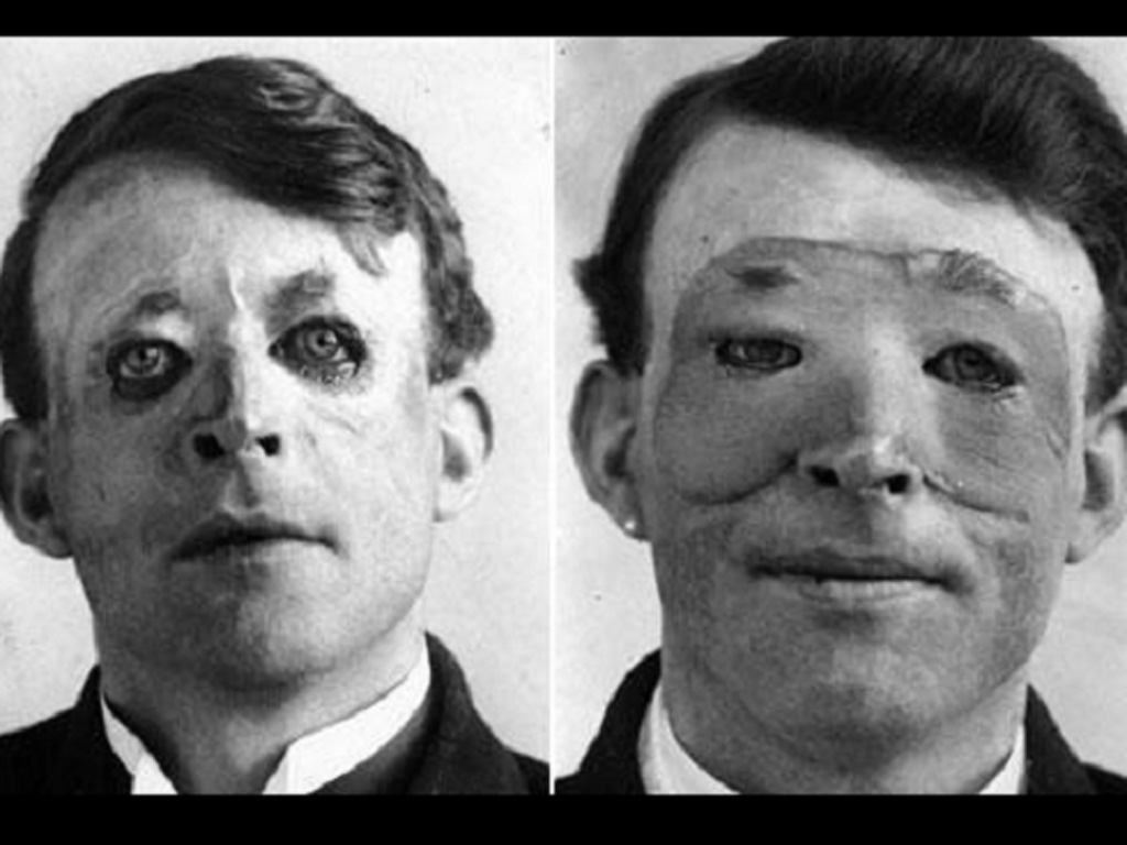 Walter Yeo, người đầu tiên được phẫu thuật thẩm mỹ, trước (trái) và sau (phải) phẫu thuật vào năm 1917 - Ảnh chụp màn hình Medical Daily