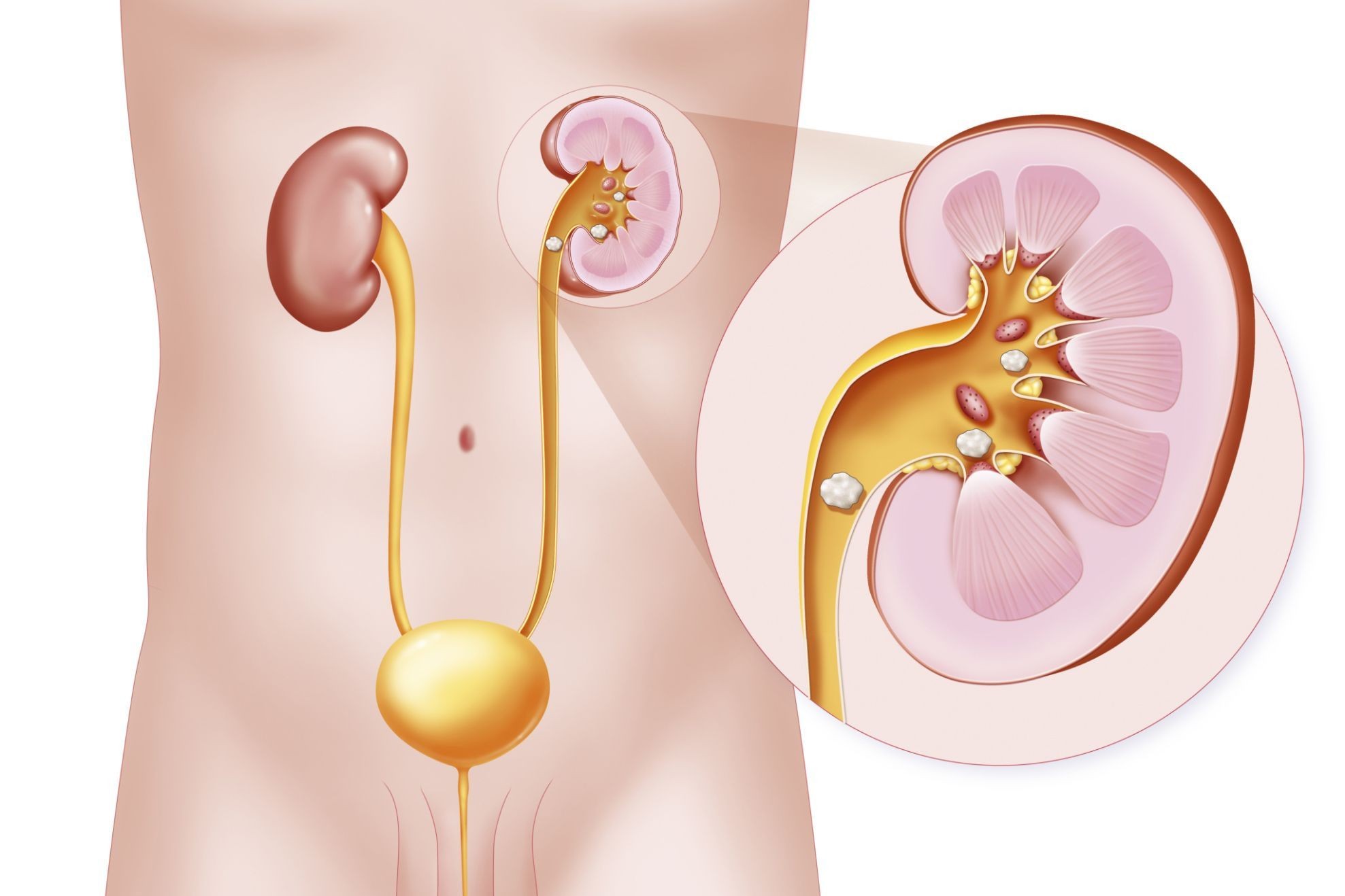 7 bệnh sỏi thường gặp