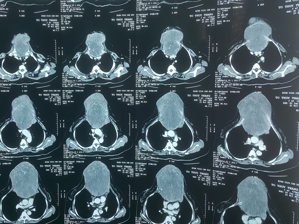 Khối u xương ức khổng lồ của bệnh nhân trên phim chụp - Ảnh do bệnh viện cung cấp