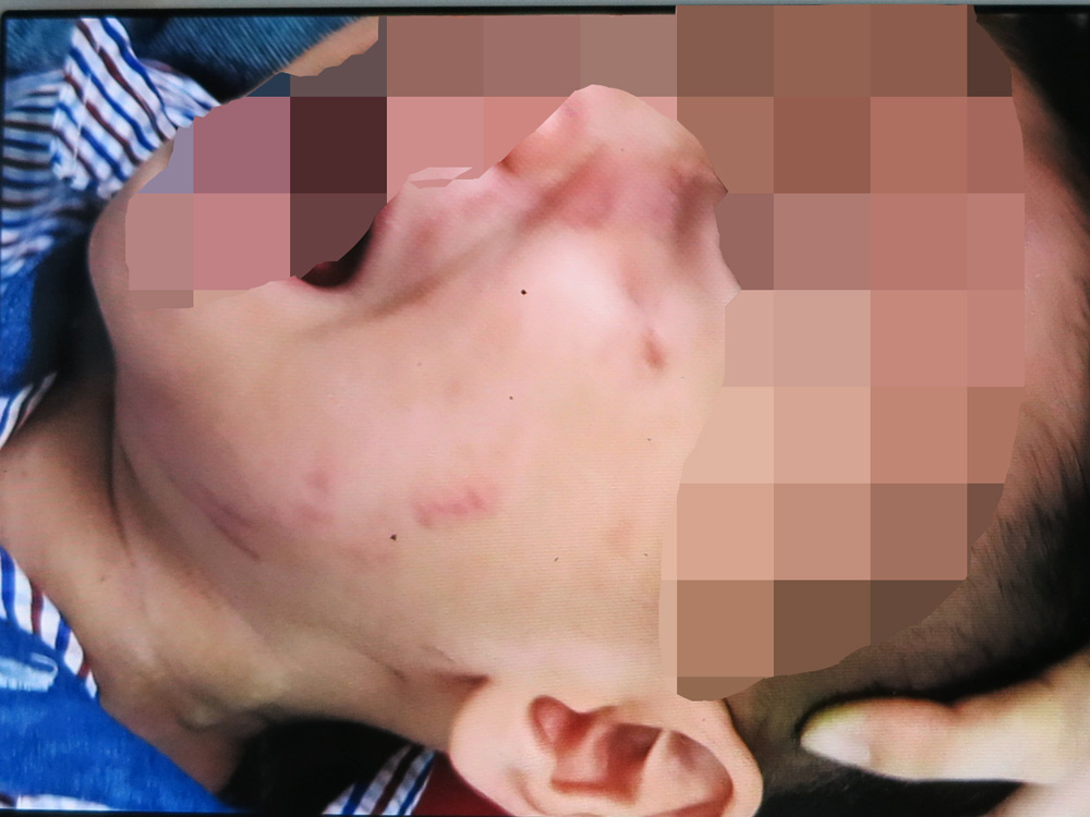 Các vết thương trên mặt bé trai 3 tuổi phải khâu 200 mũi vì bị chó cắn đang dần lành - Ảnh do bệnh viện cung cấp