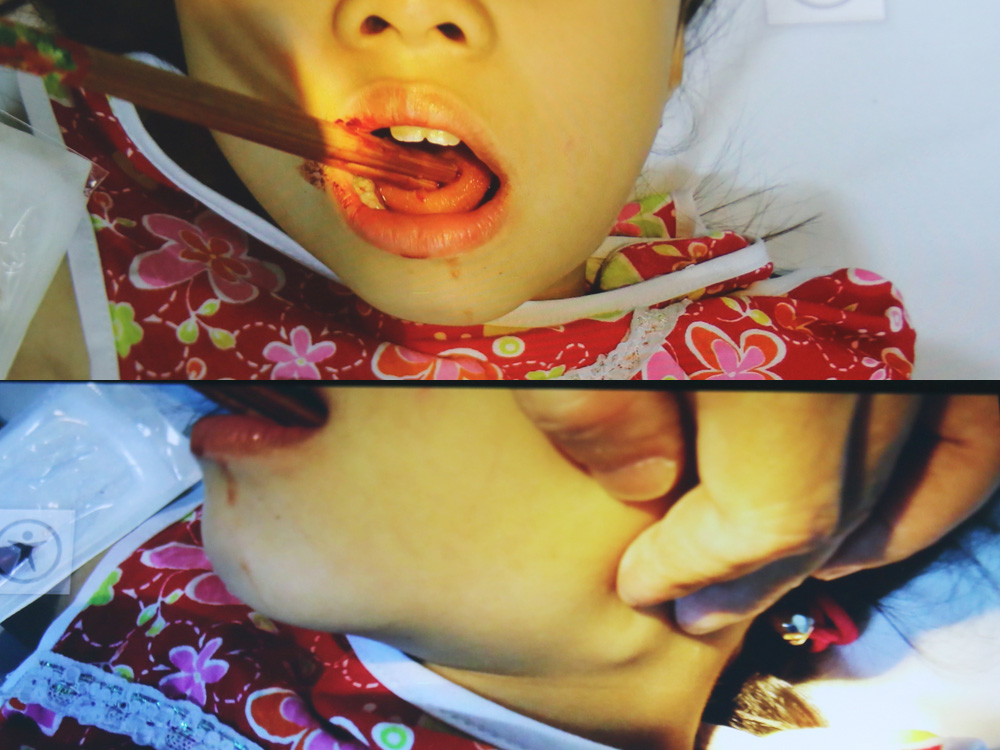 Đôi đũa đâm xuyên qua lưỡi bé gái 9 tuổi - Ảnh: bác sĩ cung cấp