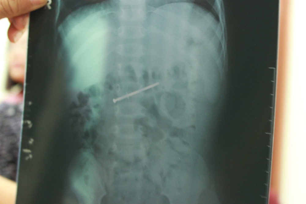 Cây đinh trong ruột non của bé trai 18 tháng qua phim chụp x-quang - Ảnh: Nguyên Mi