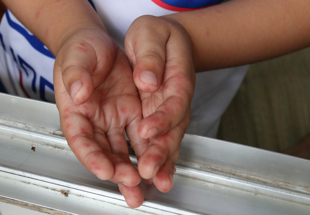 Trẻ bị TCM nổi các mụn nước ở lòng bàn tay - Ảnh; Nguyên Mi