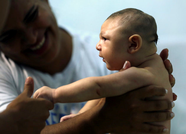 Em bé sơ sinh bị chứng đầu nhỏ - Ảnh: Reuters
