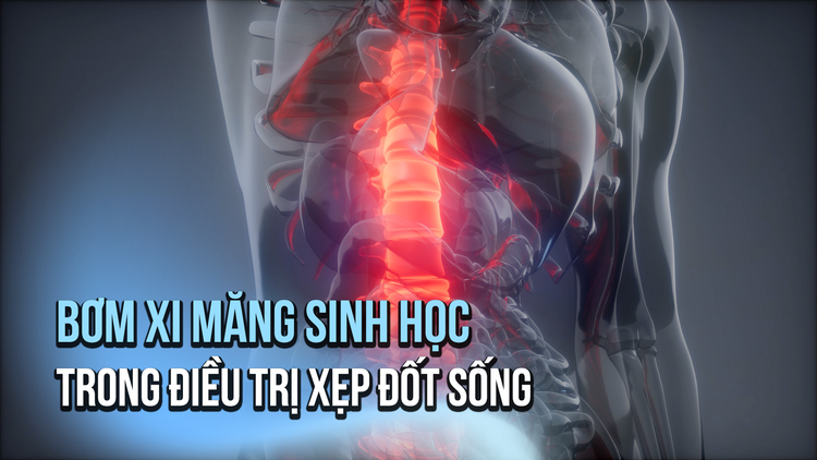 Cần lưu ý gì khi bơm xi măng sinh học trong điều trị xẹp đốt sống?